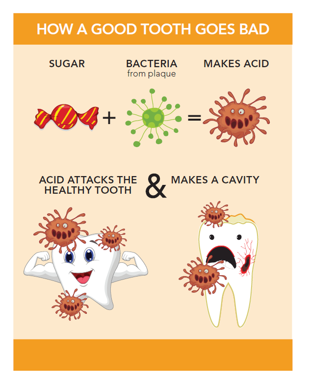 Illustration showing how a cavity happens when sugar mixes with the bacteria in your mouth to form an acid